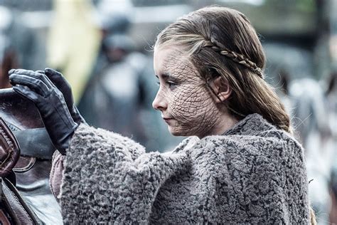 greyscale disease in real-life|Greyscale—A Mystery Dermatologic Disease on HBO’s Game of .